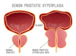 comparison of normal prostate VS one with BPH