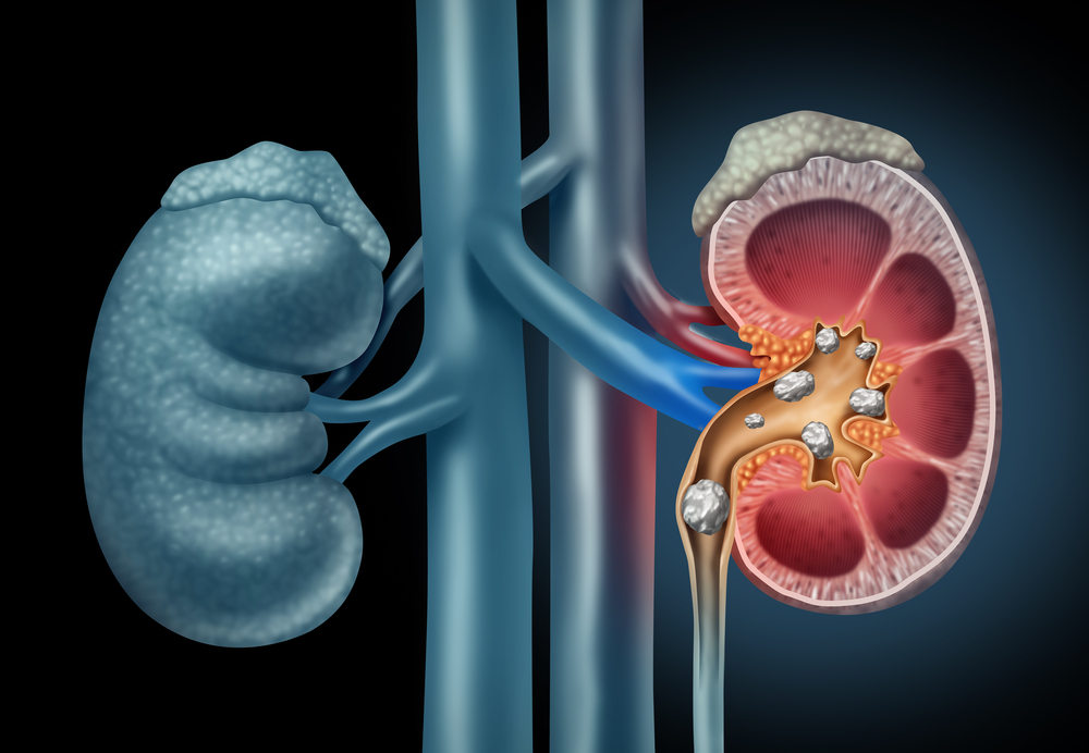 3d illustration of stones inside the kidney